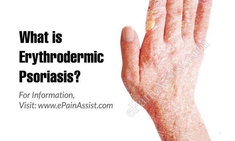 What is Erythrodermic Psoriasis: Causes, Symptoms, Treatment, Prognosis and Prevention