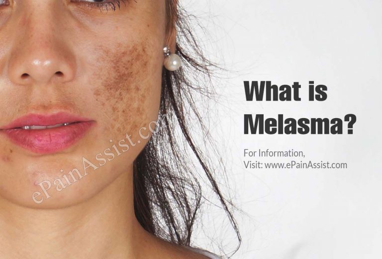 What is Melasma: Causes, Symptoms, Treatment
