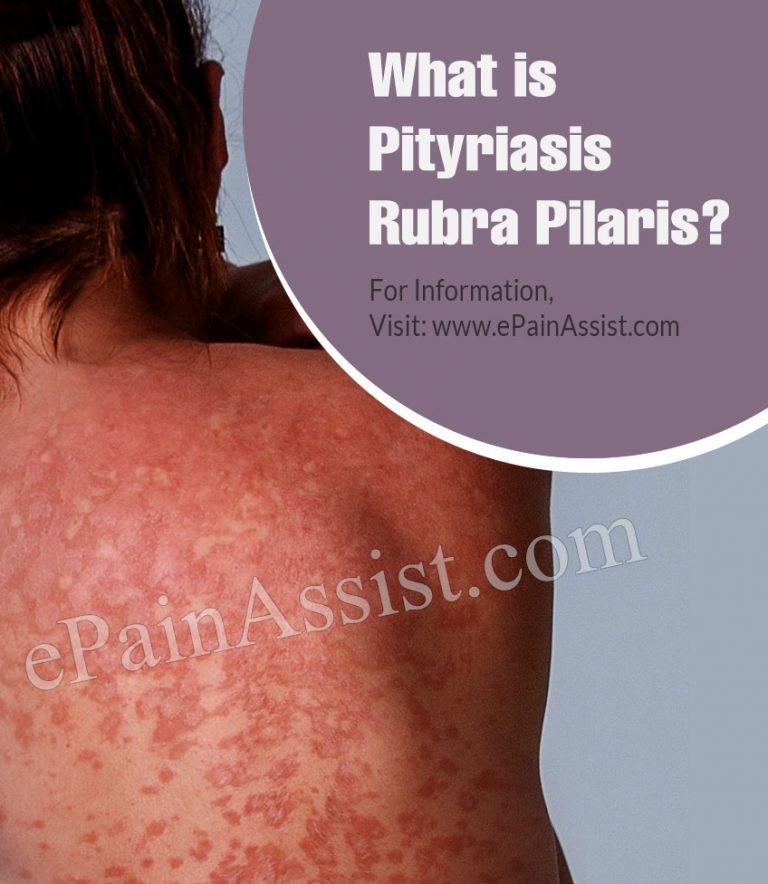 What is Pityriasis Rubra Pilaris: Types, Causes, Symptoms, Treatment, Prevention