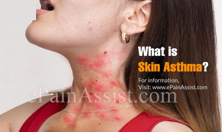 What is Skin Asthma: Causes, Symptoms, Treatment, Prevention