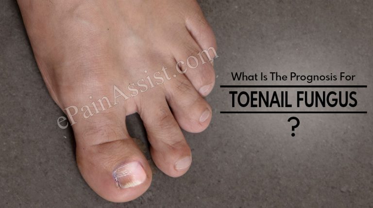 What Is The Prognosis For Toenail Fungus?