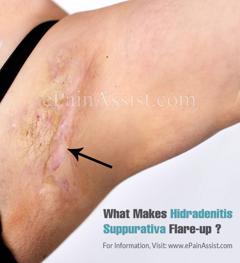 What Makes Hidradenitis Suppurativa Flare-up & How To Avoid Them?
