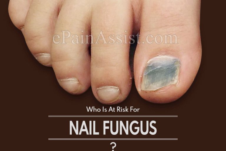 Who Is At Risk For Nail Fungus?