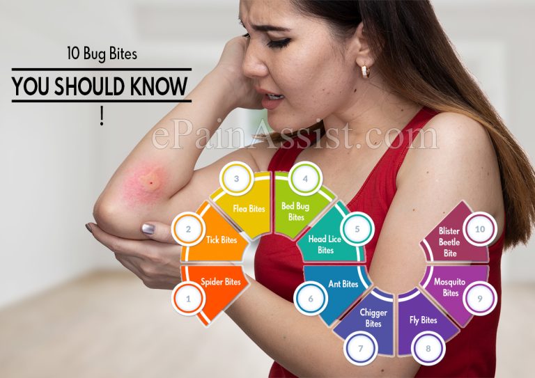 10 Bug Bites You Should Know