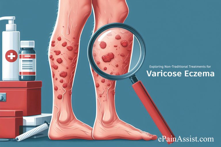 Exploring Non-Traditional Treatments for Varicose Eczema : Acupuncture, Herbal Solutions, and Specialized Massages
