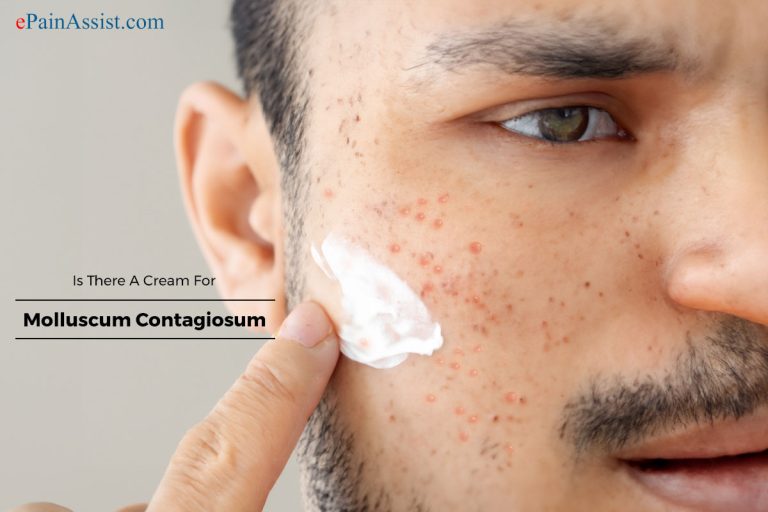 Is There A Cream For Molluscum Contagiosum?