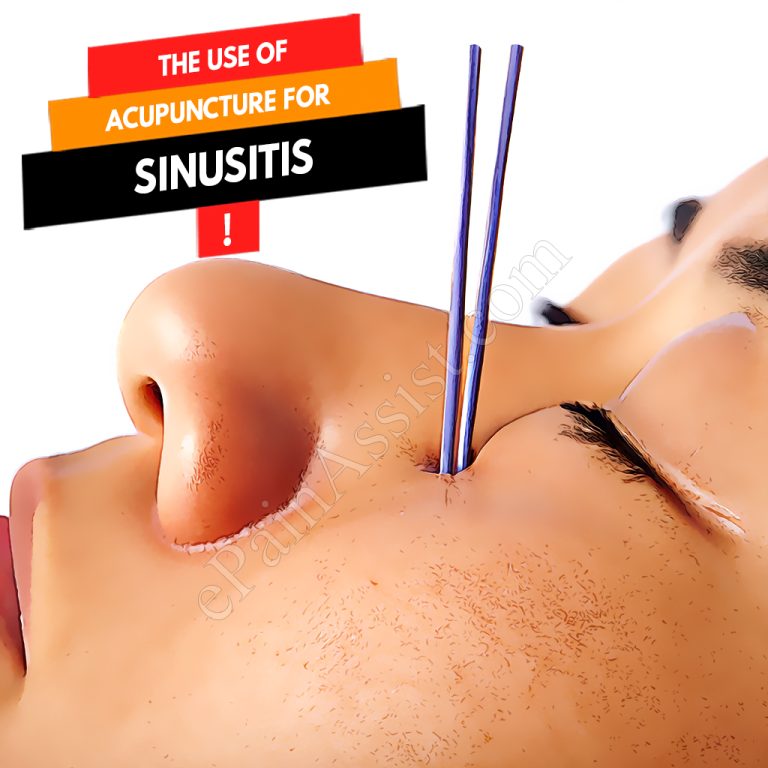 The Use of Acupuncture for Sinusitis
