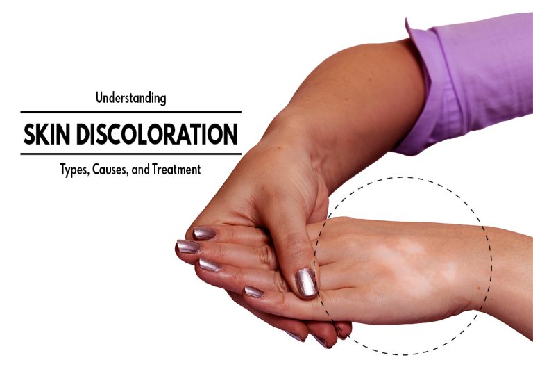 Understanding Skin Discoloration : Types, Causes, and Treatment