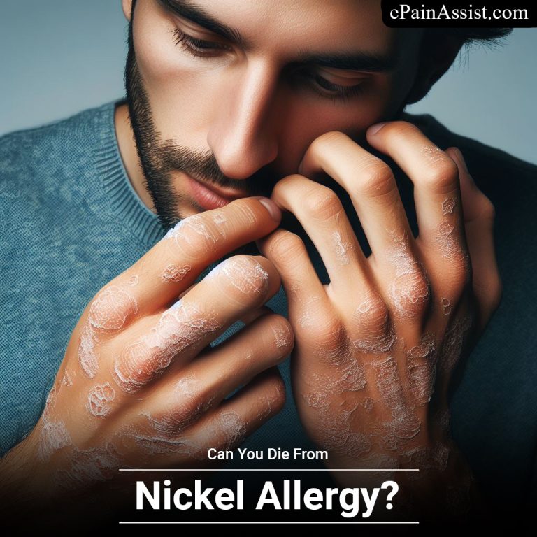 Can You Die From Nickel Allergy?