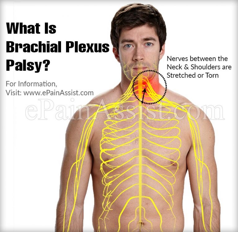 Brachial Plexus Palsy: Causes, Symptoms, Treatment, Diagnosis