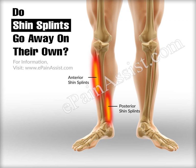Do Shin Splints Go Away On Their Own?