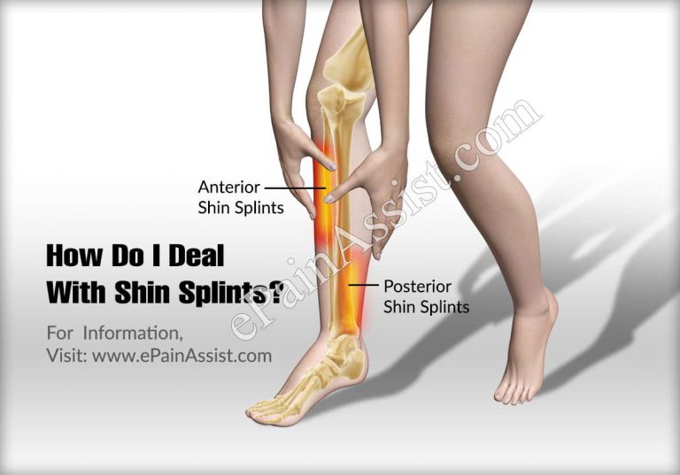 How Do I Deal With Shin Splints?