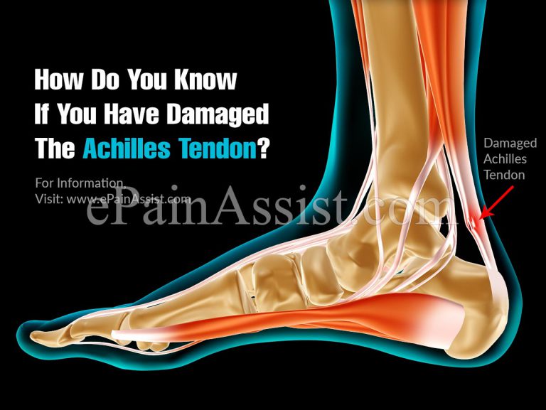 How Do You Know If You Have Damaged The Achilles Tendon?