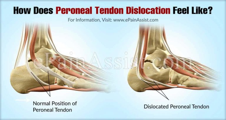 How Does Peroneal Tendon Dislocation Feel Like?