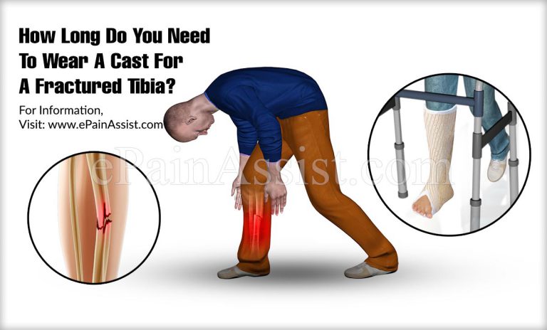 Fractured Tibia: How Long Do You Need To Wear A Cast For A Fractured Tibia?
