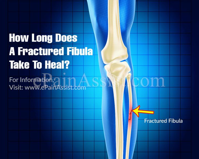 How Long Does A Fractured Fibula Take To Heal?
