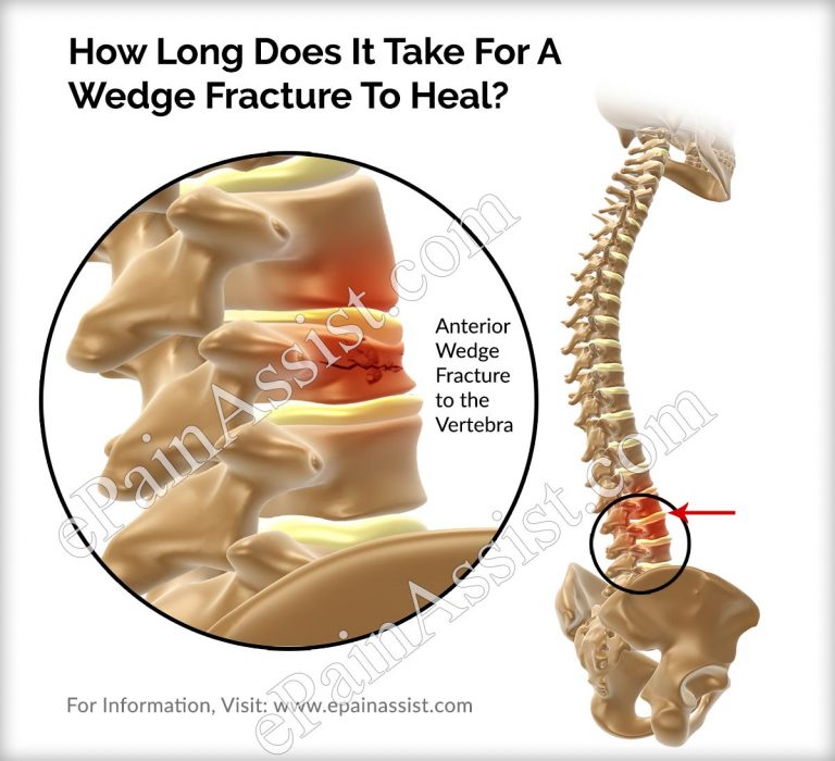 How Long Does It Take For A Wedge Fracture To Heal?