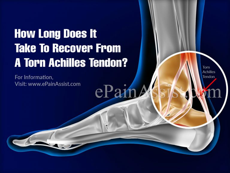 How Long Does It Take To Recover From A Torn Achilles Tendon?