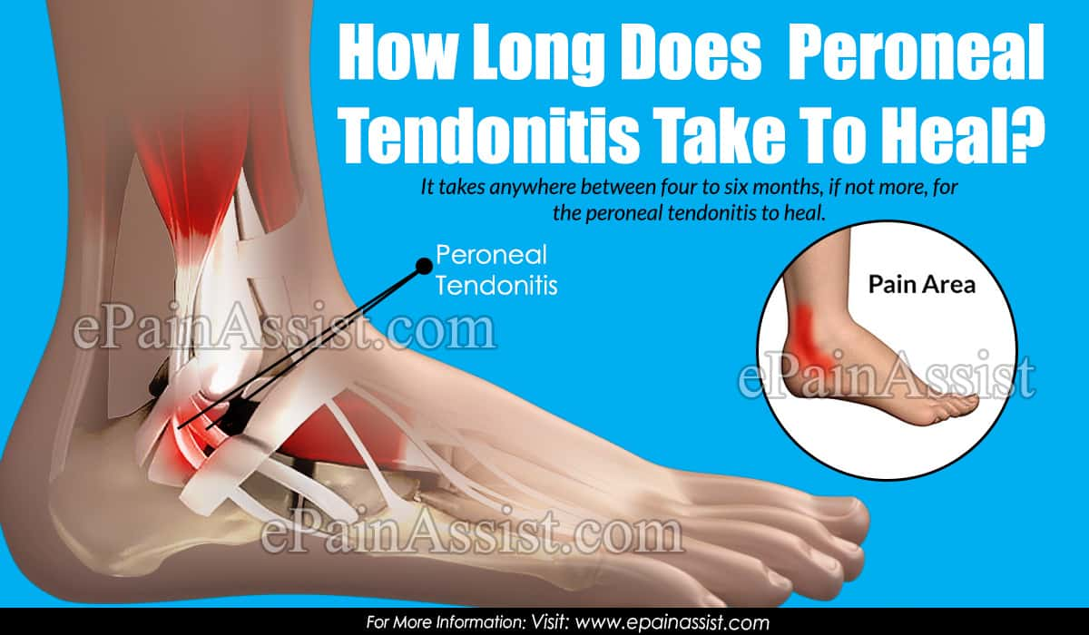 How Long Does Peroneal Tendonitis Take To Heal?