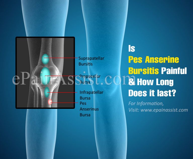 Is Pes Anserine Bursitis Painful & How Long Does it last?