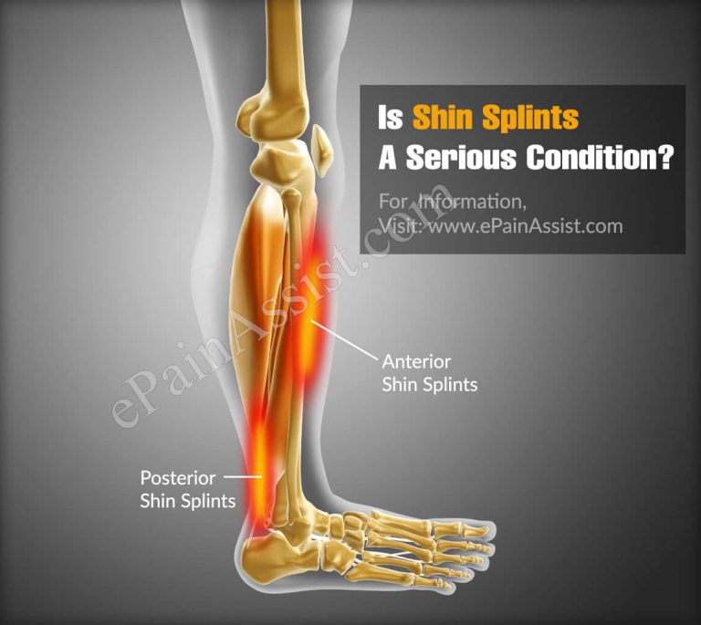 Is Shin Splints A Serious Condition?