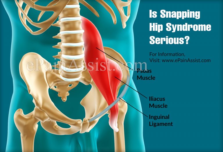 Is Snapping Hip Syndrome Serious?