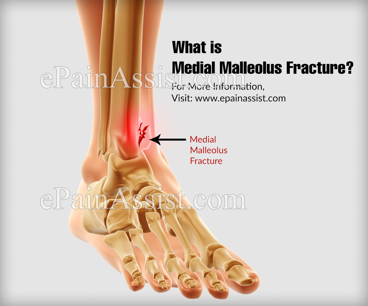 What is Medial Malleolus Fracture?