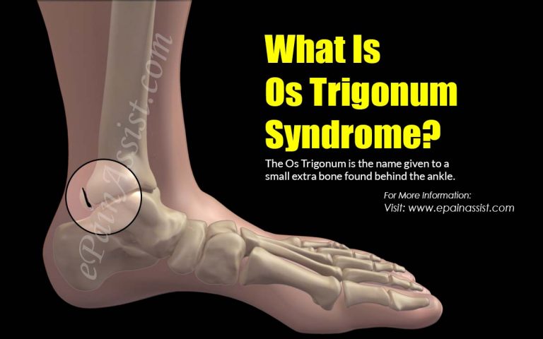 Os Trigonum Syndrome: Causes, Symptoms, Treatment