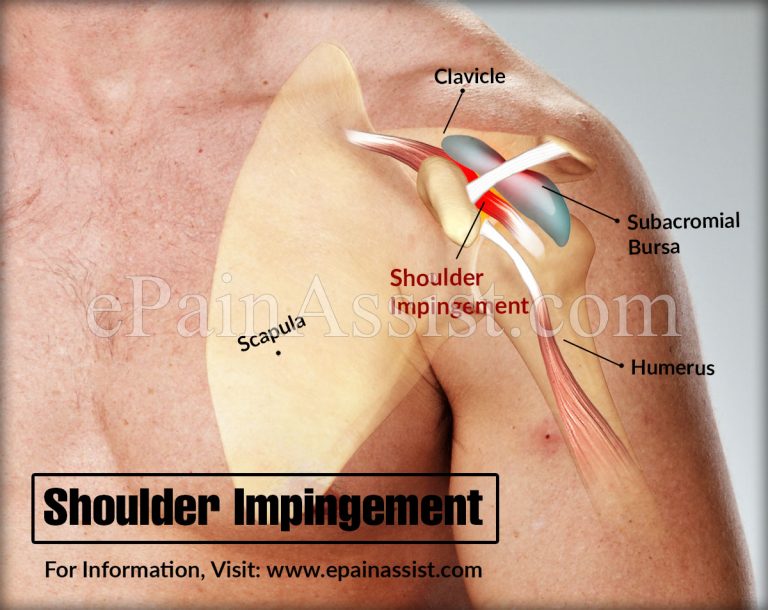 Who is at Risk for Shoulder Impingement?|Is Surgery Necessary for Treating Shoulder Impingement?