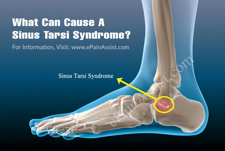 What Can Cause A Sinus Tarsi Syndrome?