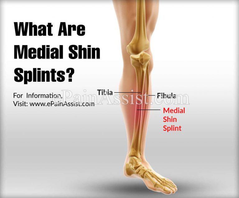 What Are Medial Shin Splints?