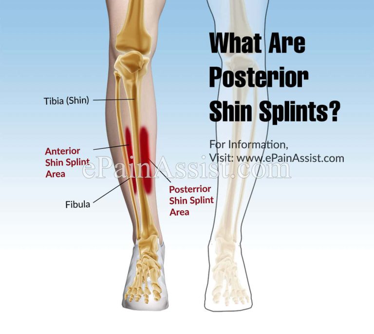 What Are Posterior Shin Splints?