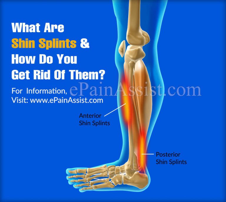 What Are Shin Splints And How Do You Get Rid Of Them?