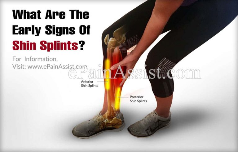 What Are The Early Signs Of Shin Splints?