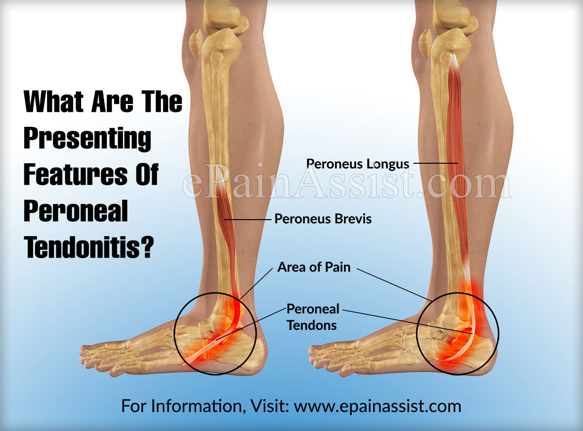 What Are The Presenting Features Of Peroneal Tendonitis?