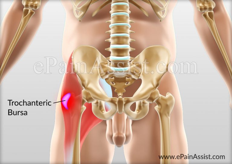 What Are The Treatment Options For Trochanteric Bursitis?