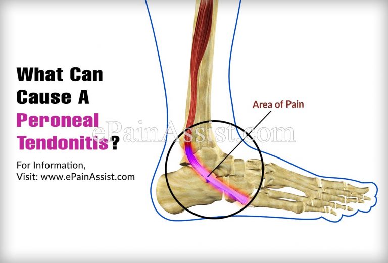 What Can Cause A Peroneal Tendonitis?