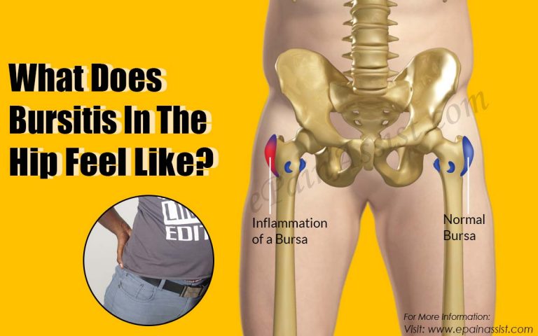 What Does Bursitis In The Hip Feel Like?