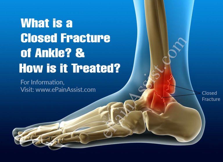 What is a Closed Fracture of Ankle & How is it Treated?|Causes, Symptoms, Diagnosis of Closed Fracture of Ankle