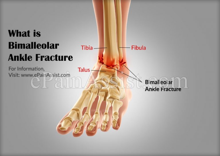 What is Bimalleolar Ankle Fracture: Causes, Symptoms, Treatment, Recovery Time, Surgery