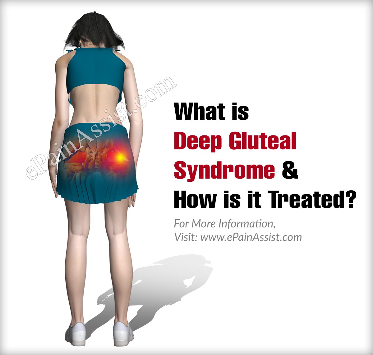 What is Deep Gluteal Syndrome & How is it Treated?