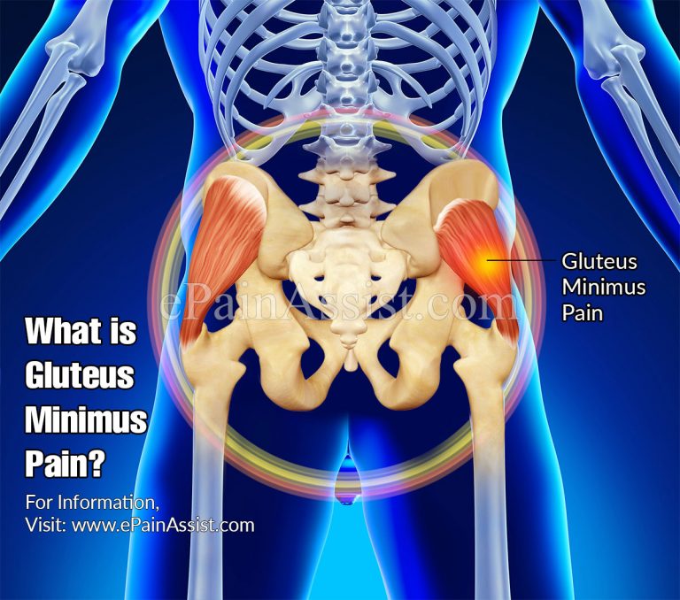 What is Gluteus Minimus Pain & How is it Treated?|Causes, Symptoms, Exercises for Gluteus Minimus Pain