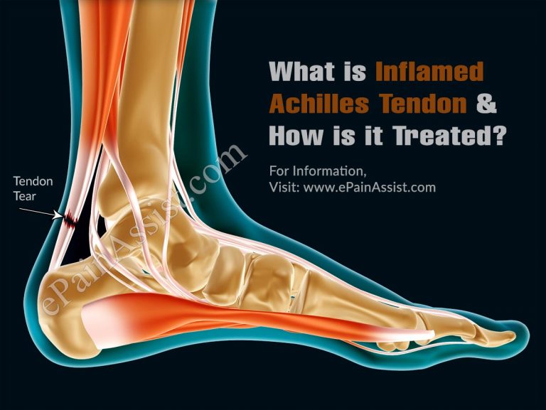 What is Inflamed Achilles Tendon & How is it Treated?