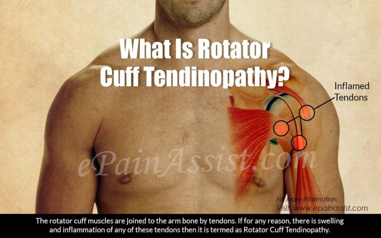 What is Rotator Cuff Tendinopathy?