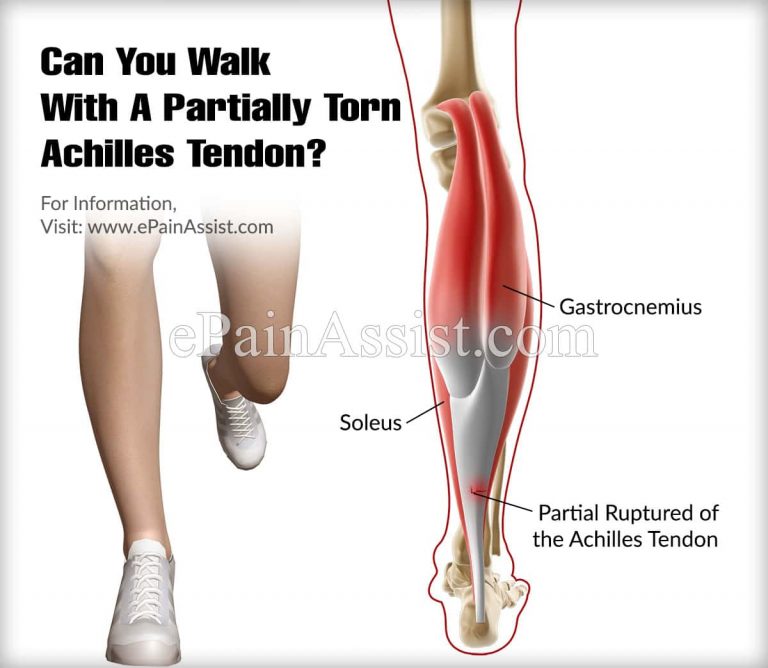 Can You Walk with a Partially Torn Achilles Tendon? Overview and Implications