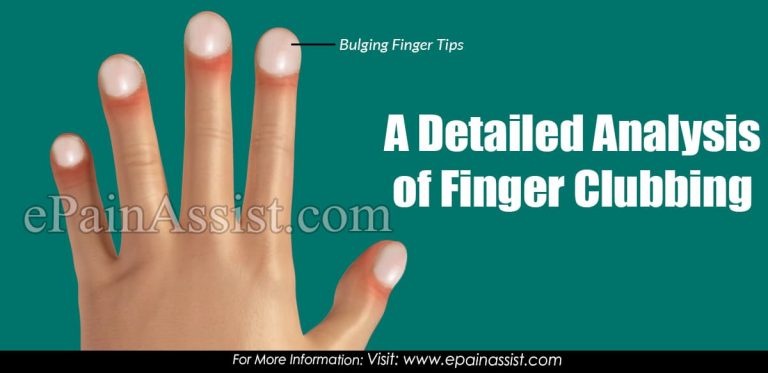 A Detailed Analysis of Finger Clubbing