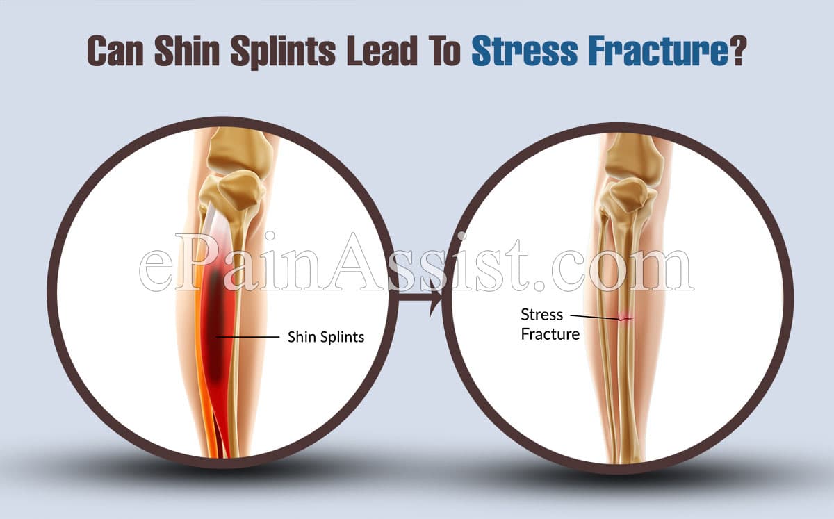 Can Shin Splints Lead To Stress Fracture?