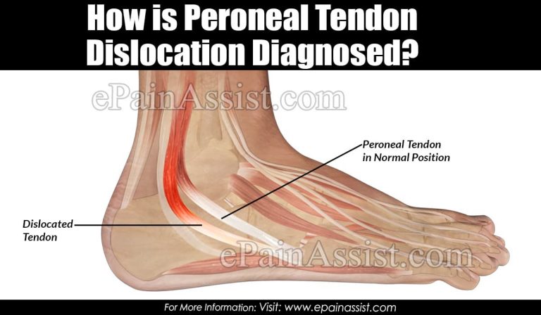 How is Peroneal Tendon Dislocation Diagnosed?