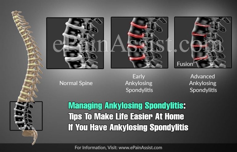 Managing Ankylosing Spondylitis: Tips To Make Life Easier At Home If You Have Ankylosing Spondylitis