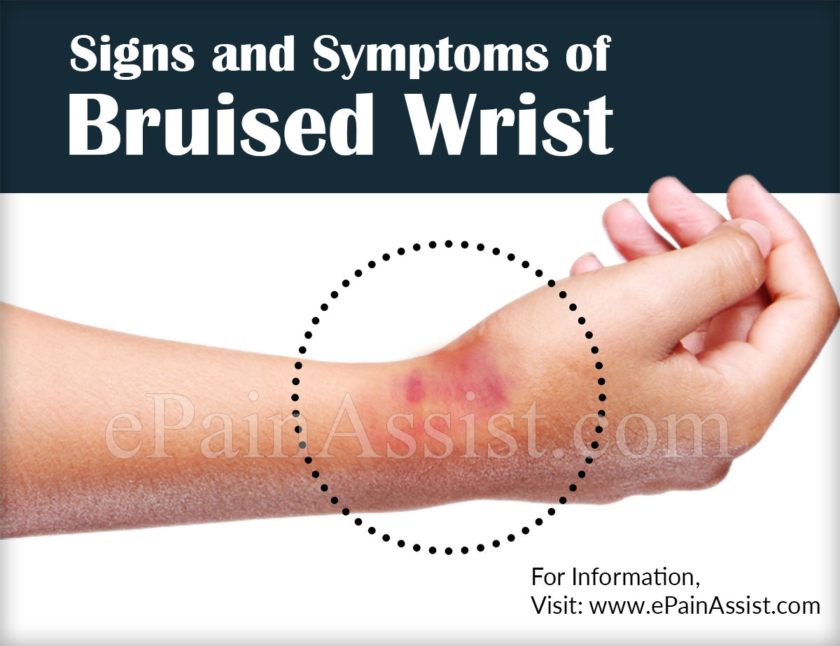 Signs and Symptoms of Bruised Wrist or Wrist Contusion